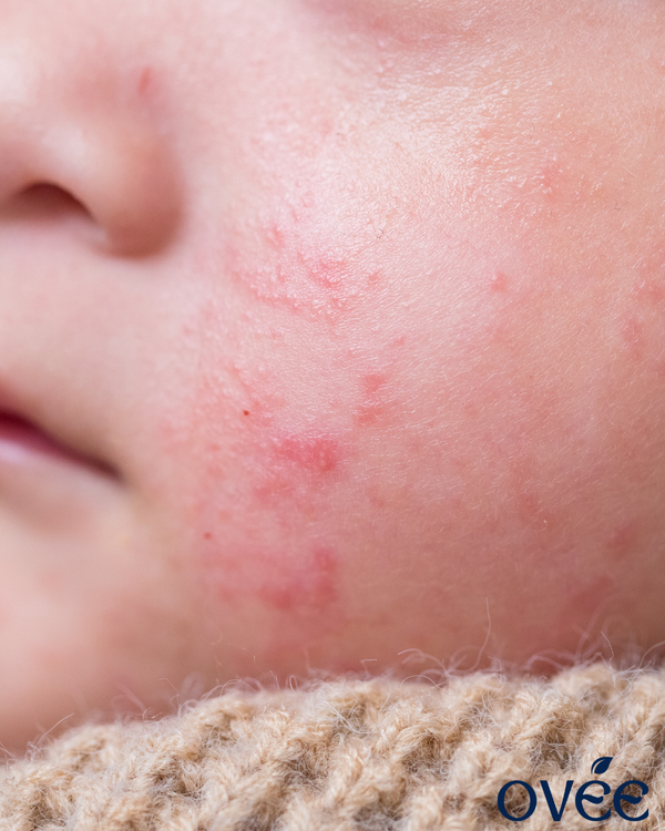 What Triggers an Eczema Flare-Up (and How to Avoid Them)