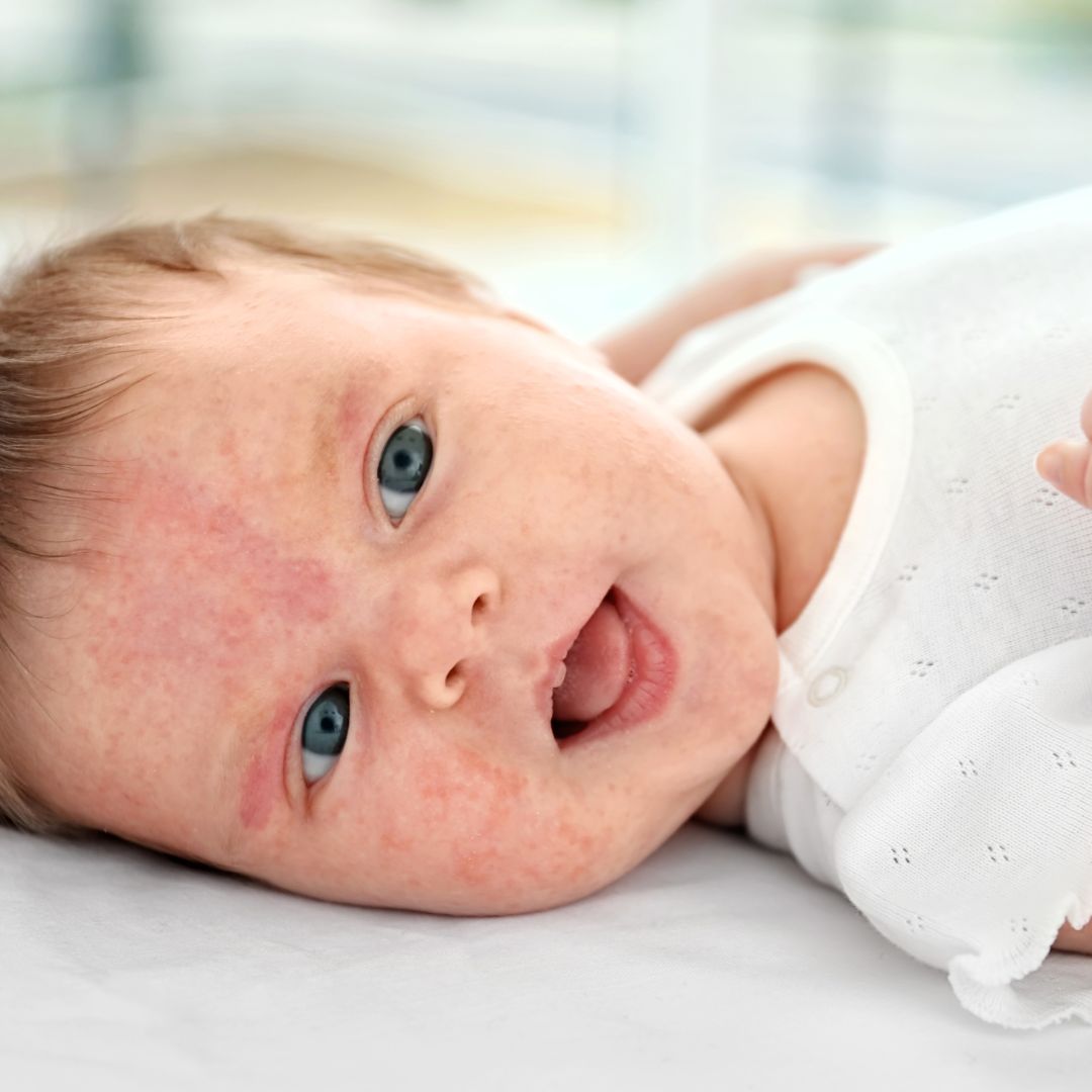 Baby with red, dry eczema patches on their cheeks and forehead